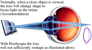 PRESBYOPIA