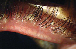 blepharitis_eye