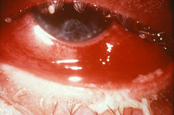 coniunctivitis_eye