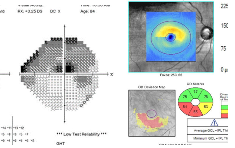 octglaucoma